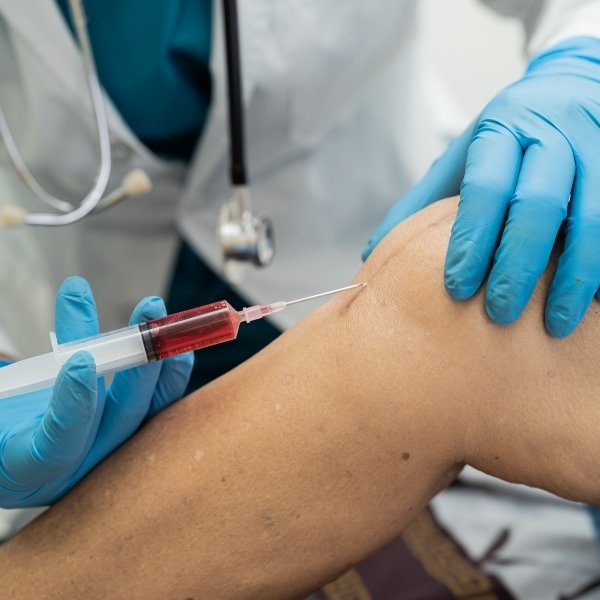 Tratamiento de Plasma Rico en Plaquetas en Santa Cruz